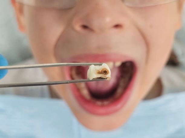 Best Emergency Wisdom Teeth Removal in Stanton, NE